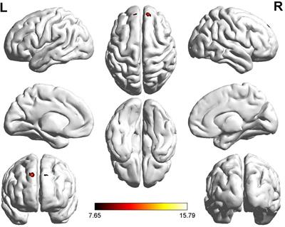 Recent-onset and persistent tinnitus: Uncovering the differences in brain activities using resting-state functional magnetic resonance imaging technologies